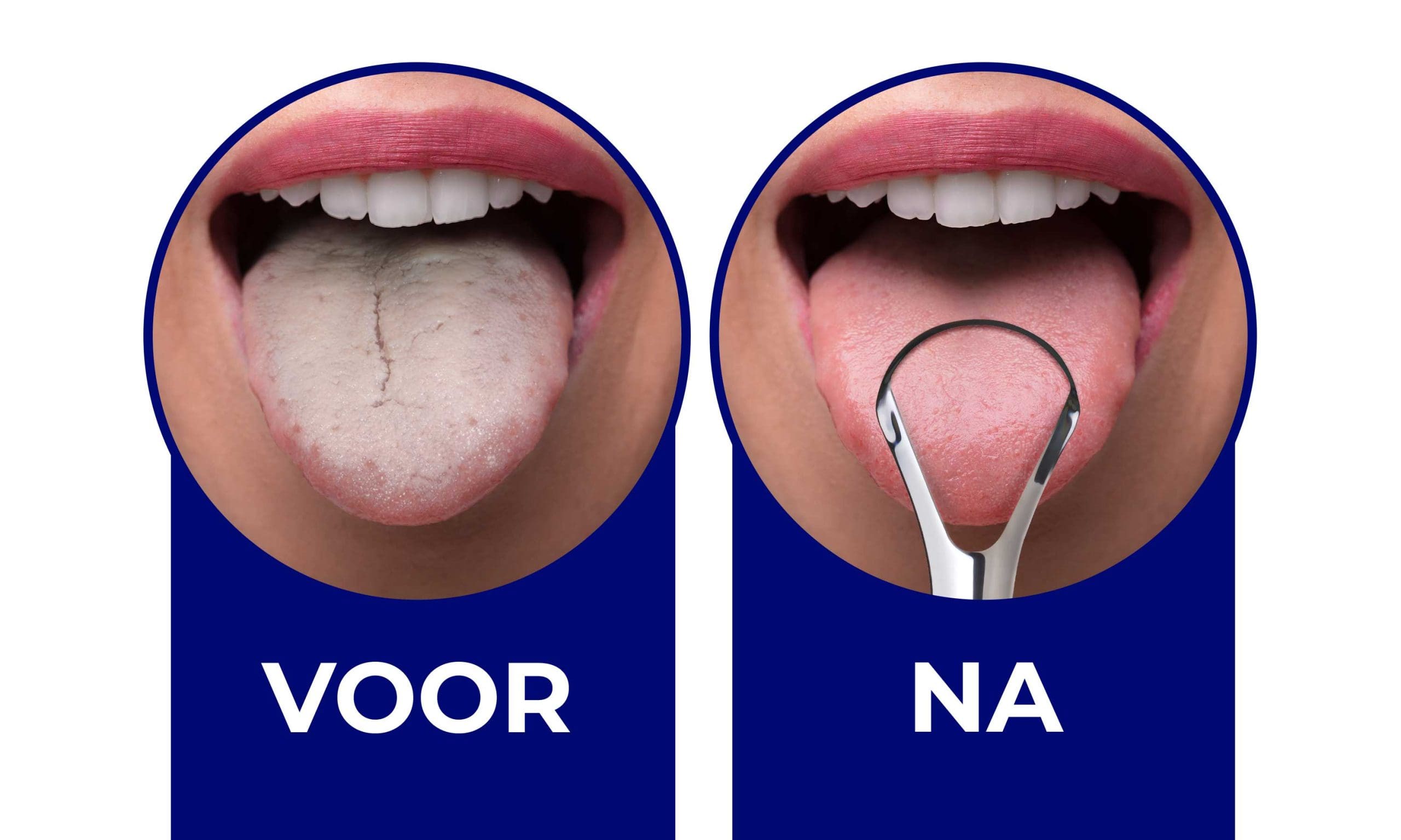 240920 ORAVIX Blog BB HowTo BeforeAfter NL 001 Voor en na het gebruik van een tongschraper