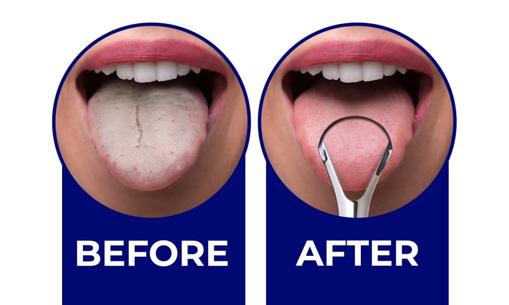 Before-After Before and After using a tongue scraper: the picture Before shows a white coating on the tongue, while the tongue appears pink and healthier after