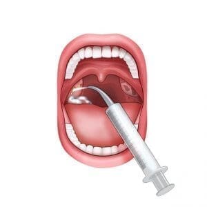 Tonsil Stone Remover Kit Curved Tip Syringe