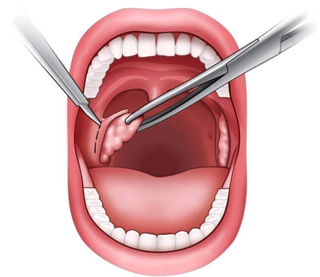 Tonsillectomy